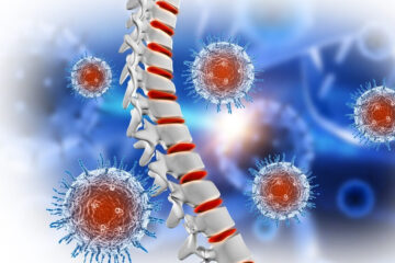 Malignant Bone Tumors